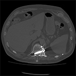 Thoracic CT. Vertebral corpectomy, screw in spinal canal