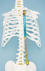 Vertebral titanium expandable rib