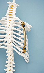 Expandable titanium rib