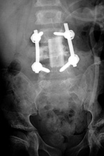 Vertebral bone strut