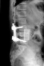 Vertebral bone strut