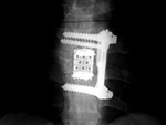 Harms vertebral cage