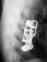 Harms vertebral cage