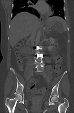 Zero-profile ALIF CT