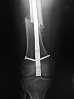 Retrograde femoral IM rod extrusion