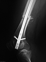 Retrograde femoral IM rod extrusion