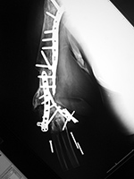 Humerus fixation plate loosening and screw displacement