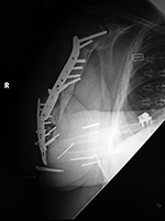 Humerus plate loosening and screw displacement