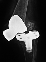 Disrupted left total knee prosthesis frontal view