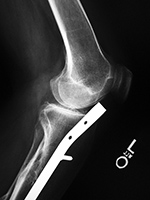Left knee antegrade intramedullary rod displacement into knee joint