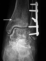Left ankle stress fracture AP view
