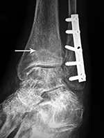 Left ankle stress fracture oblique view