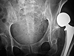 Left hip unipolar prosthesis dislocation
