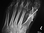 Left MTP joint fusion screw fracture