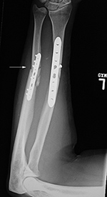 Left ulna LCD plate failure