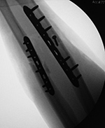 Left ulna LCD plate postoperative view