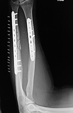 Left LCD plate revision