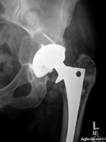 Left hip arthroplasty: polyethylene liner wear with associated osteolysis and particle disease