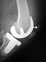 Left total knee prosthesis patellar button dislocation