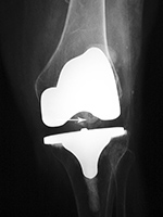 Right total knee prosthesis patellar button dislocation