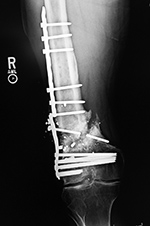 Right femur periarticular plate breakage