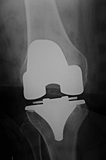 Right TKA in postoperative period
