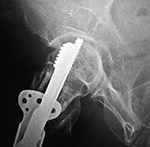 Fixation screw projecting into right hip joint