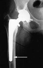 Total femoral osteolysis
