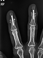 Accutrak screws