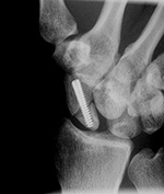 Acutrak screw
