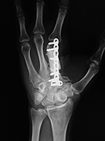 Antibiotic cement spacer