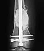 Bone cement in metastatic renal cell sarcoma