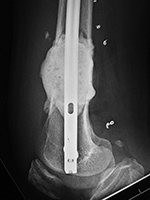 Bone cement in metastatic renal cell sarcoma