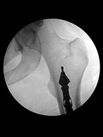 Bone graft harvesting