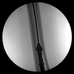 Bone graft harvesting