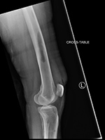 Bone graft harvesting postoperative image