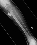 Ultrasonic bone stimulator AP view