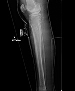 Ultrasonic bone stimulator lateral view