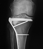 Buttress plate and bone substitute
