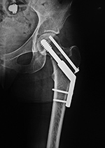 Dynamic Compression Screw