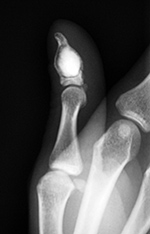 Bone substitute placed in curretted enchondroma