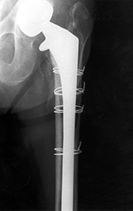 Femoral cerclage wires