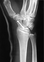 Herbert screw in a scaphoid fracture