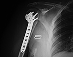 Periarticular plate