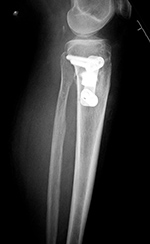 Hydroxyapetite bone wedge