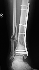 Right tibia LISS plate and bone substitute