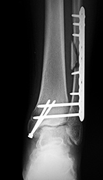 Left ankle dynamic compression plate and two syndesmotic screws