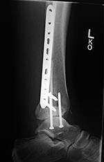 Left ankle dynamic compression plate and two syndesmotic screws