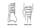 Neutralization and Buttress plates