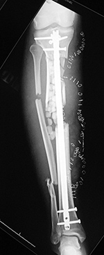 Right tibia bone graft